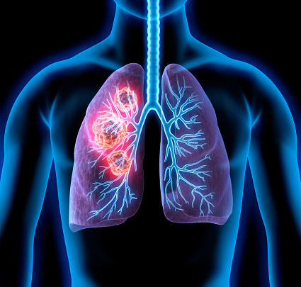 Less Than One in 20 Eligible Adults Receives Lung Cancer Screening