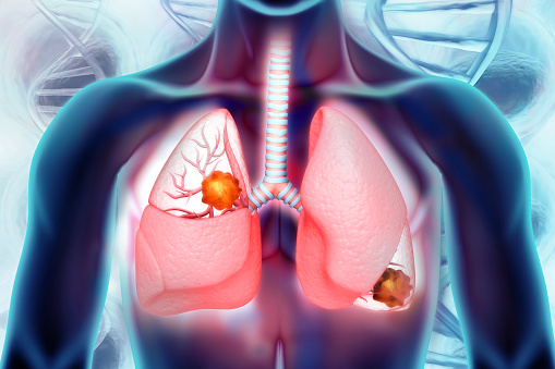 Prognostic Model Predicts Overall Survival for Metastatic Non-Small Cell Lung Cancer