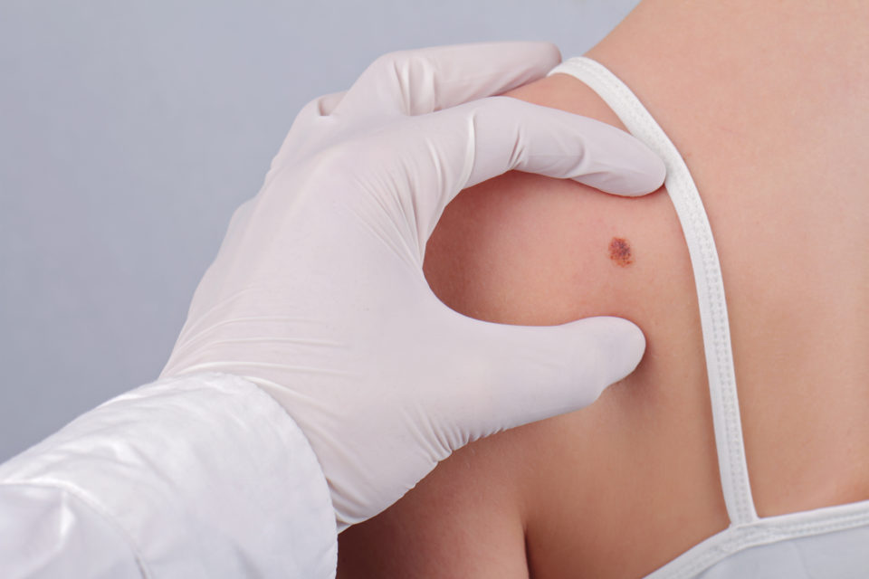 Barriers to Physician Skin Exam ID'd for Young Melanoma Survivors