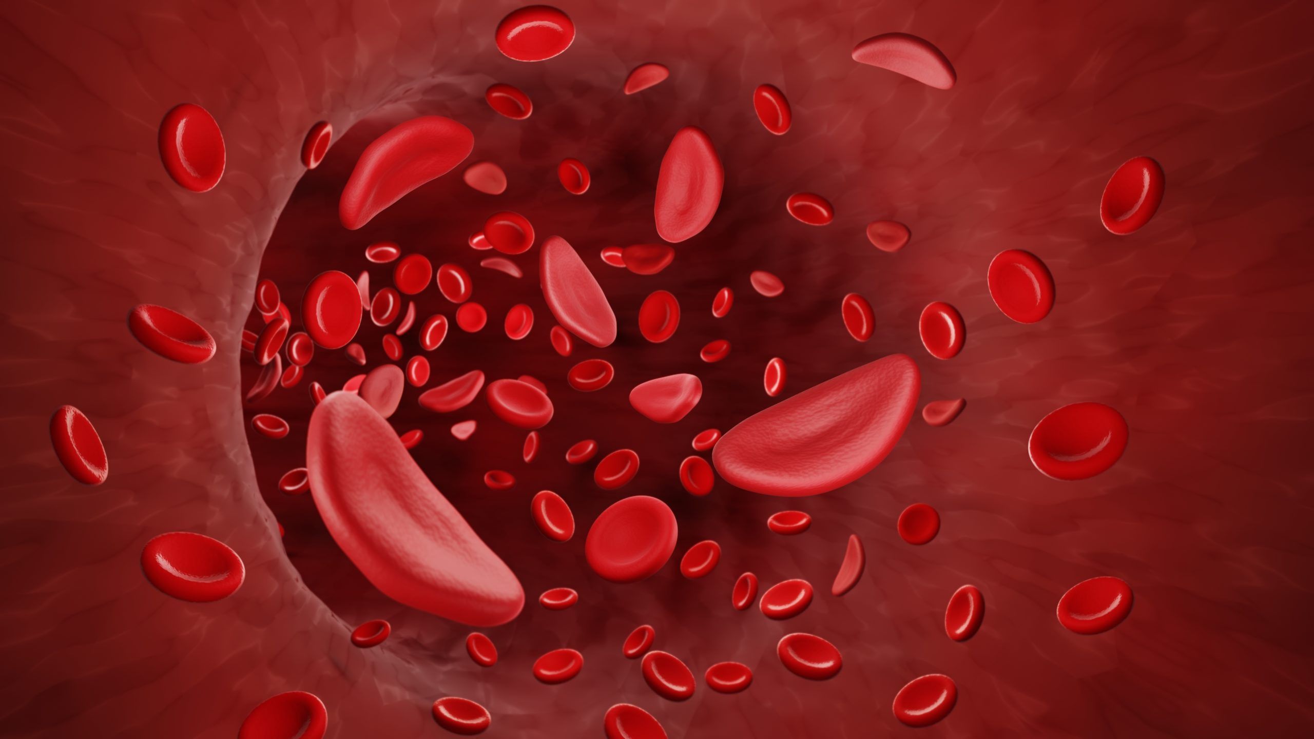 Etavopivat Improves Anemia and Hemolysis in Sickle Cell Disease