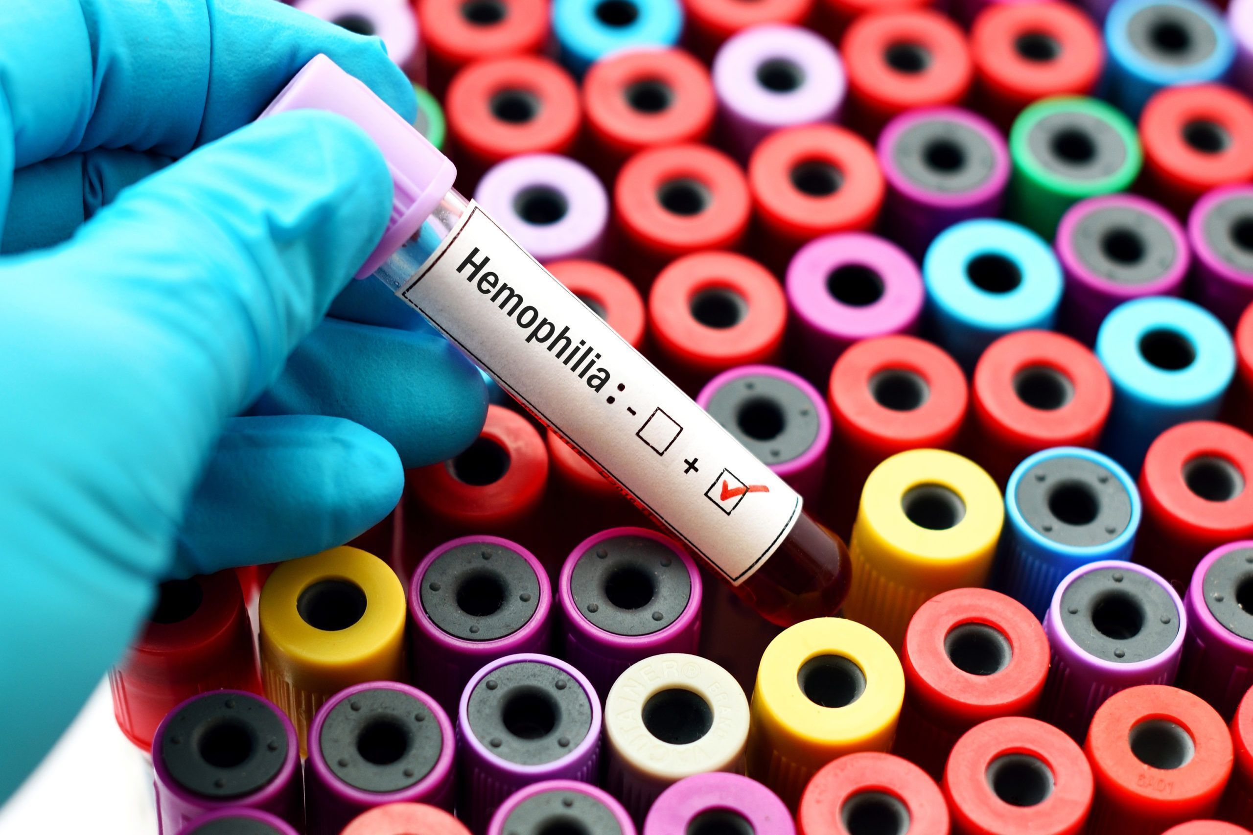 In Acquired Hemophilia A, Emicizumab Enhances Bleeding Prophylaxis