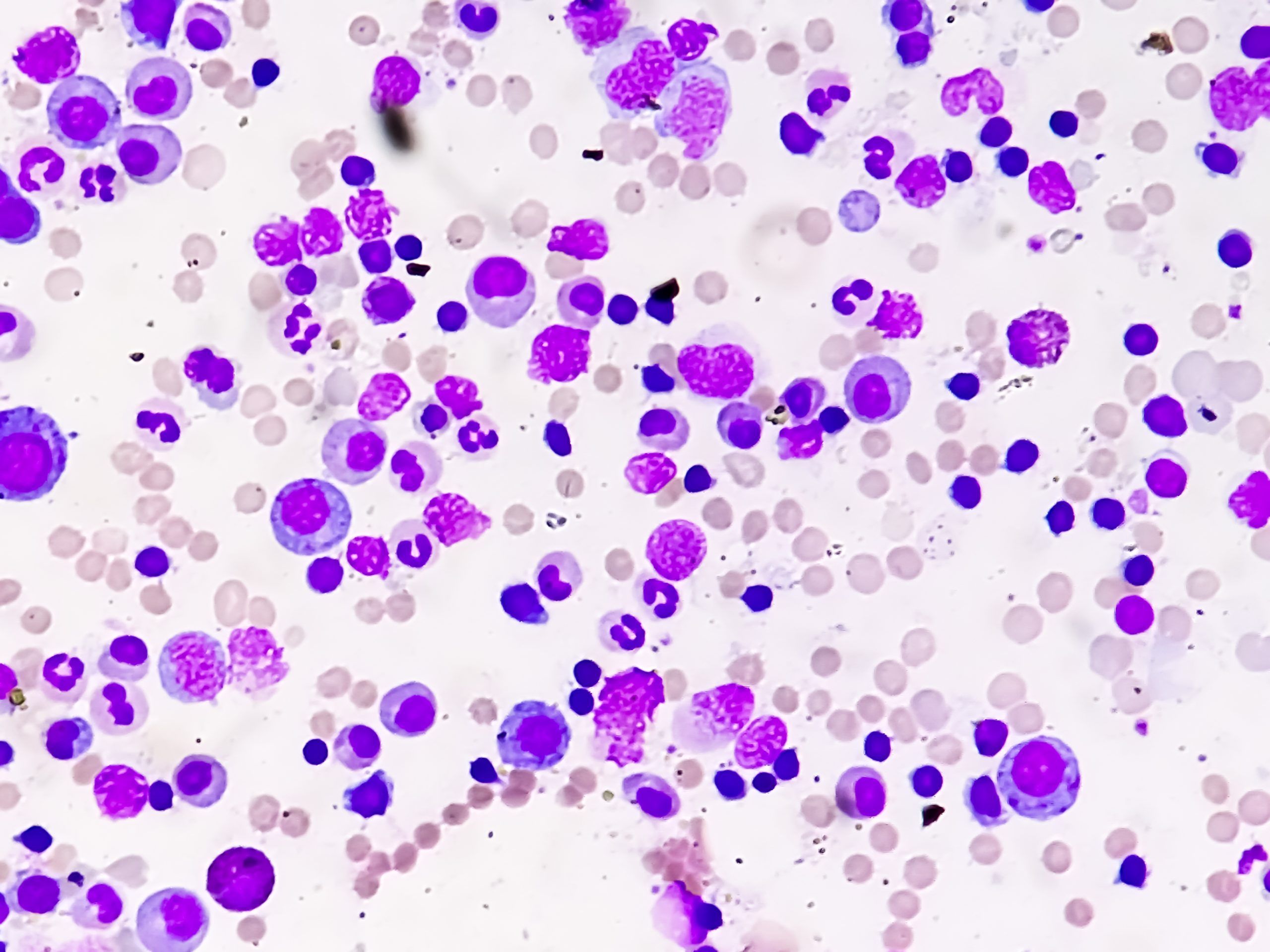 CD34+ Graft Cell Dose in Allogeneic Peripheral Blood Stem Cell Transplantation