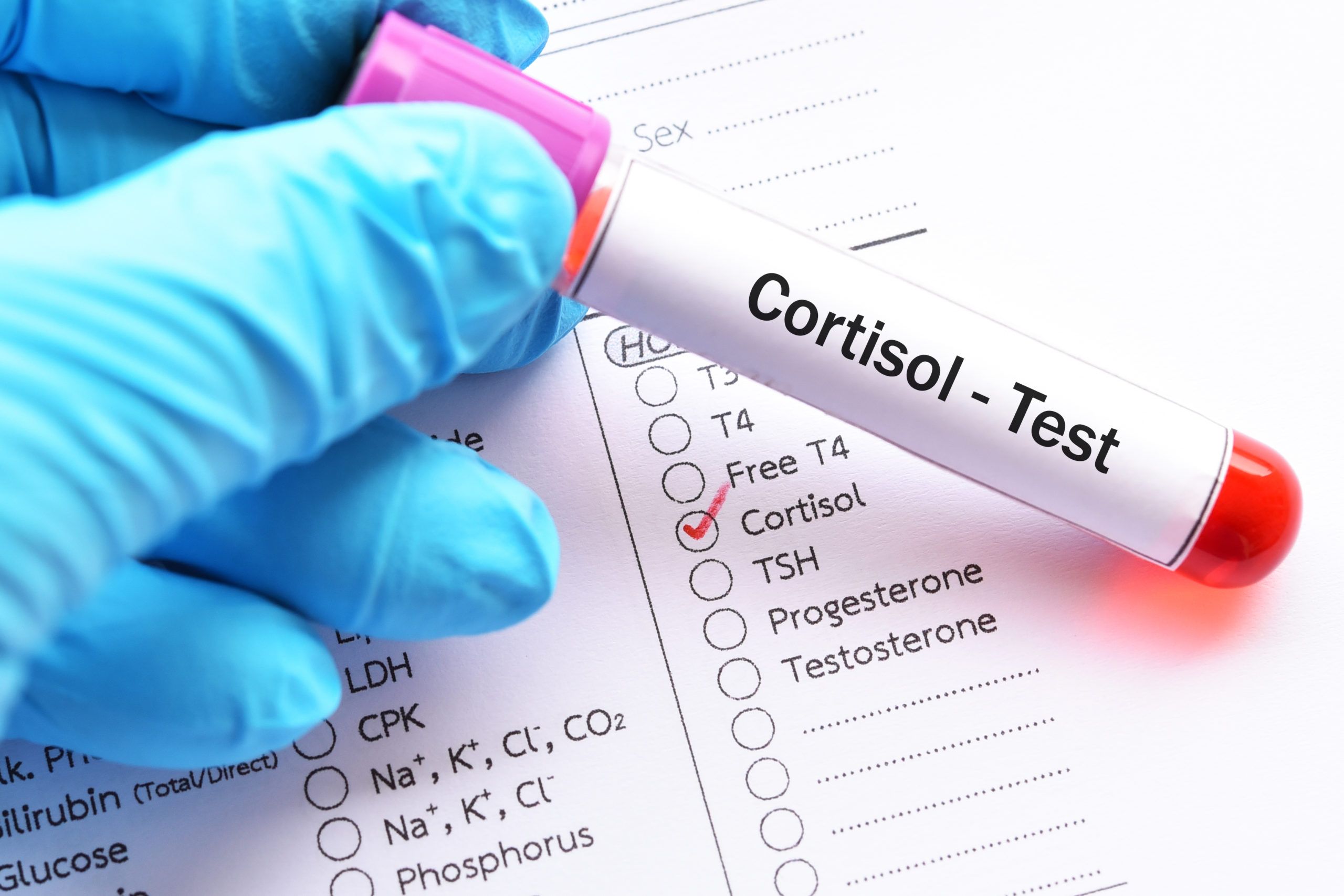 Anxiety and Cortisol May Contribute to Disparities in Breast Cancer Outcomes